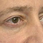 Eyelid Surgery For Men Before & After Patient #2476