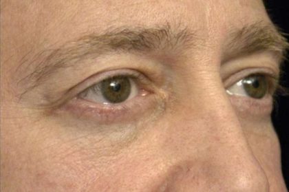 Eyelid Surgery For Men Before & After Patient #2476