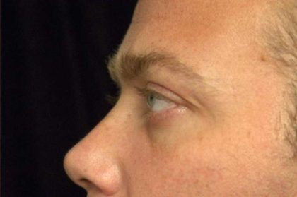 Eyelid Surgery For Men Before & After Patient #2481
