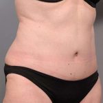 Tummy Tuck Before & After Patient #450