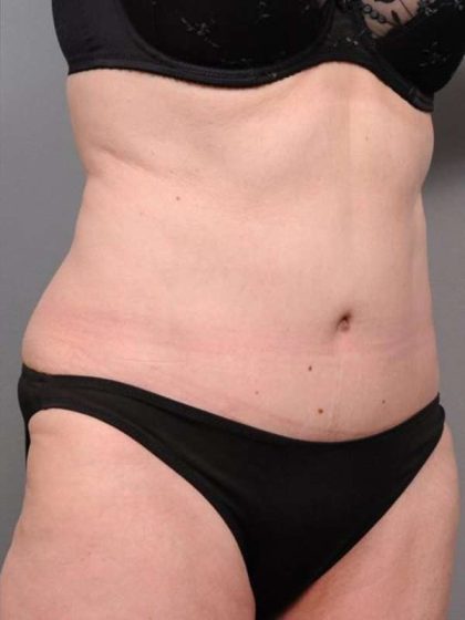 Tummy Tuck Before & After Patient #450