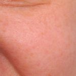 IPL Photofacial Before & After Patient #2548