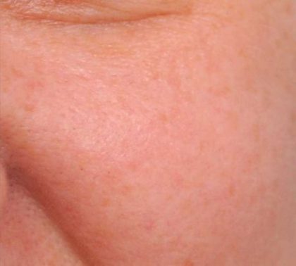 IPL Photofacial Before & After Patient #2548