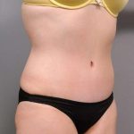 Tummy Tuck Before & After Patient #463