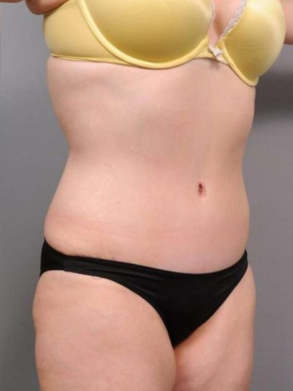 Tummy Tuck Before & After Patient #463