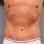 Tummy Tuck Before & After Patient #489