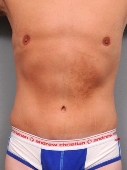 Tummy Tuck Before & After Patient #489