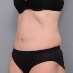 Tummy Tuck Before & After Patient #497