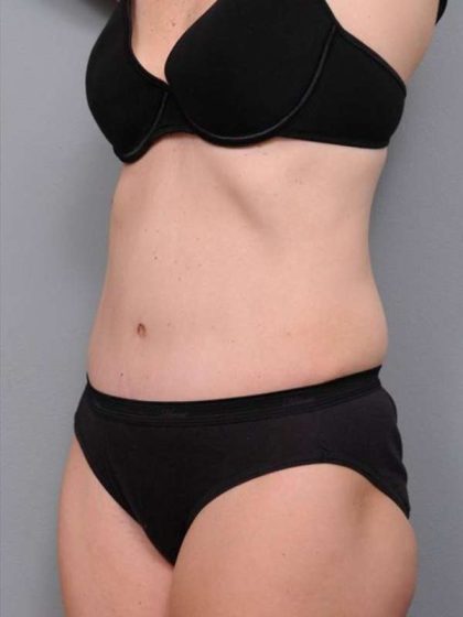 Tummy Tuck Before & After Patient #497