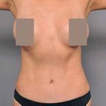 Tummy Tuck Before & After Patient #504