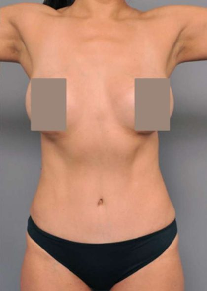 Tummy Tuck Before & After Patient #504