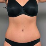Tummy Tuck Before & After Patient #515