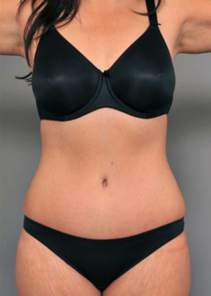 Tummy Tuck Before & After Patient #515
