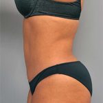 Tummy Tuck Before & After Patient #522