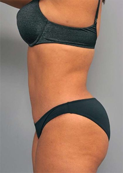 Tummy Tuck Before & After Patient #522