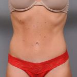 Tummy Tuck Before & After Patient #537