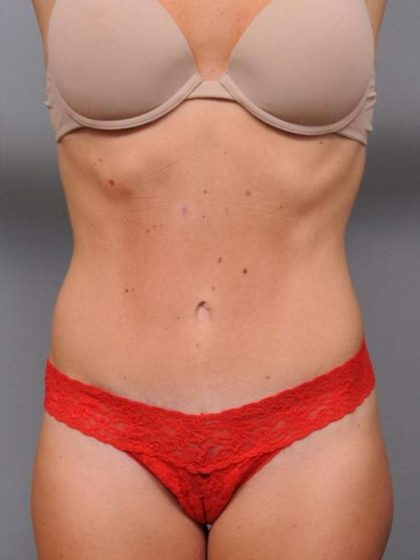 Tummy Tuck Before & After Patient #537