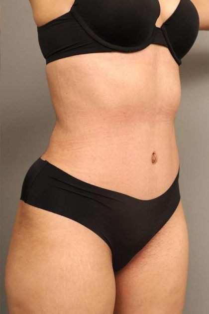 Liposuction Before & After Patient #550