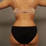 Liposuction Before & After Patient #563