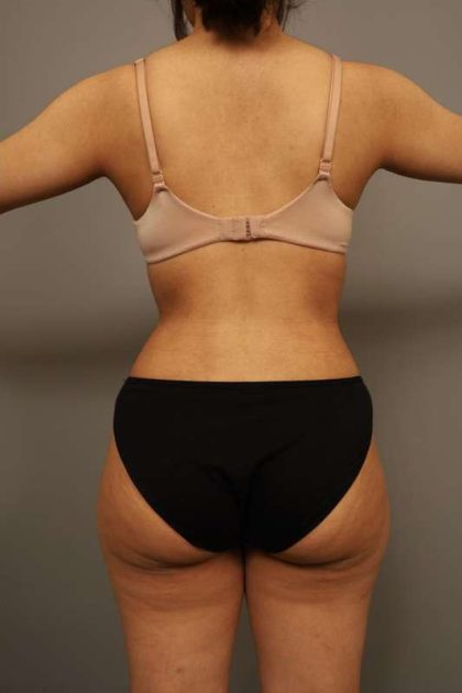 Liposuction Before & After Patient #563