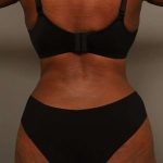 Tummy Tuck Before & After Patient #574
