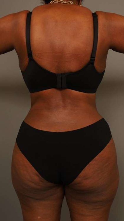 Tummy Tuck Before & After Patient #574