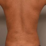 Liposuction Before & After Patient #581