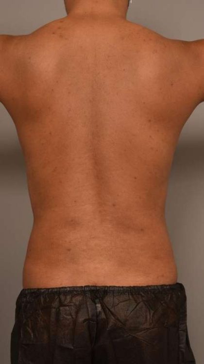 Liposuction Before & After Patient #581