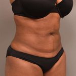 Liposuction Before & After Patient #604