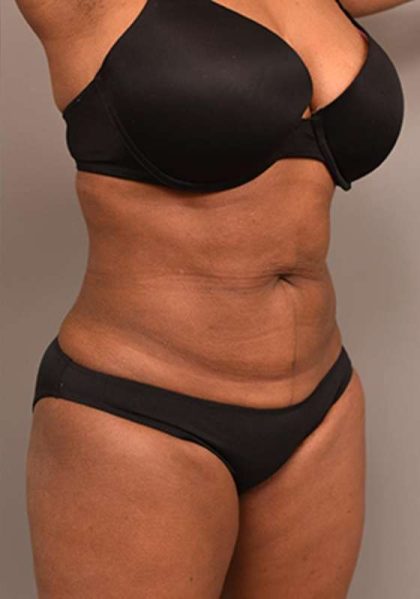 Liposuction Before & After Patient #604