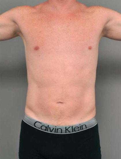 Liposuction Before & After Patient #618