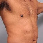 Liposuction Before & After Patient #626