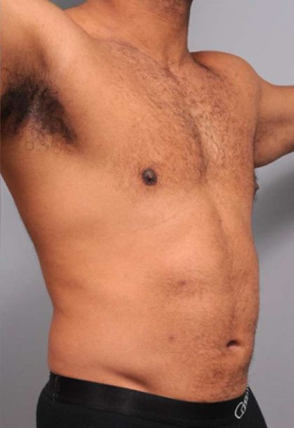 Liposuction Before & After Patient #626