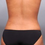 Liposuction Before & After Patient #635