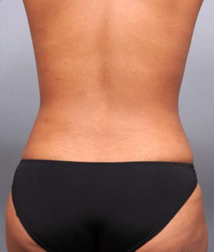 Liposuction Before & After Patient #635