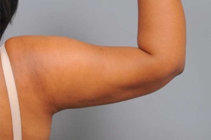 Liposuction Before & After Patient #655