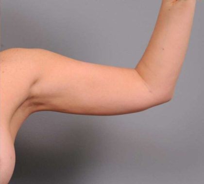 Liposuction Before & After Patient #669