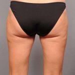 Liposuction Before & After Patient #674