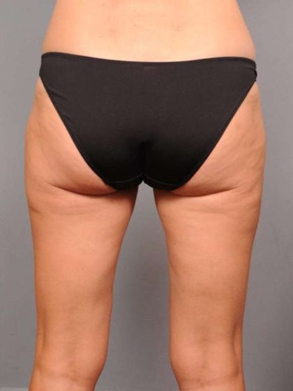 Liposuction Before & After Patient #674