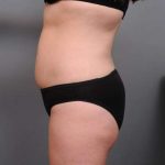 Liposuction Before & After Patient #681