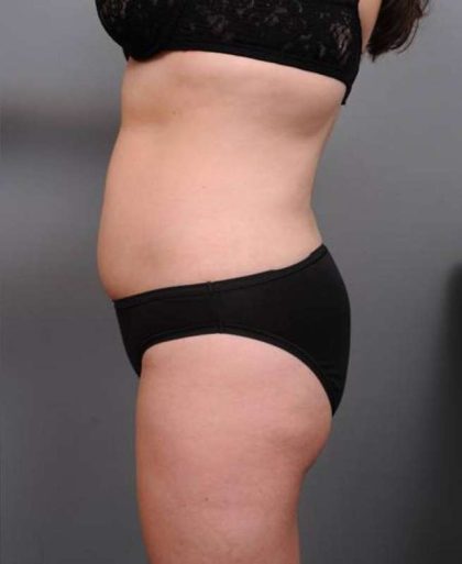 Liposuction Before & After Patient #681