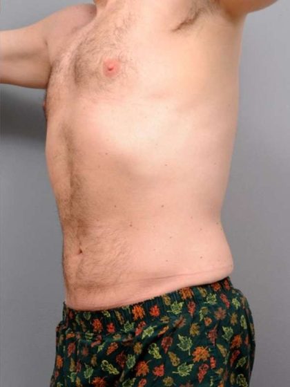 Liposuction Before & After Patient #688