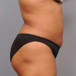 Liposuction Before & After Patient #695
