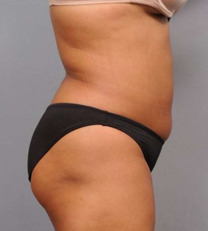 Liposuction Before & After Patient #695