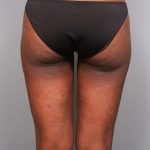 Liposuction Before & After Patient #709