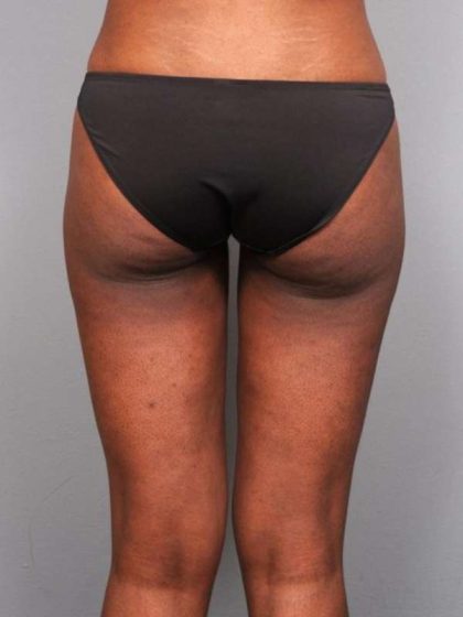 Liposuction Before & After Patient #709