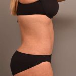 Tummy Tuck Before & After Patient #273