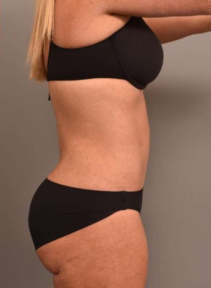 Tummy Tuck Before & After Patient #273