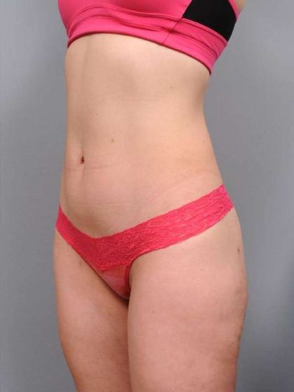 Liposuction Before & After Patient #716