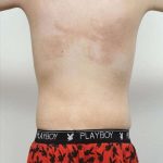 Liposuction Before & After Patient #721